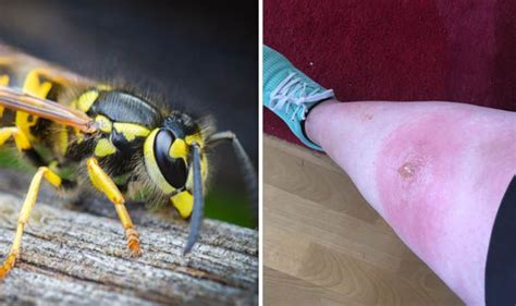 WASP INVASION: Shocking pictures show how sting became pus-filled lump in just 24 hours | UK ...