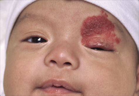 Topical Treatment for Capillary Hemangioma of the Eyelid Using β ...