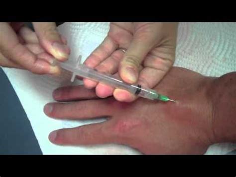 How to remove your ganglion cyst - YouTube