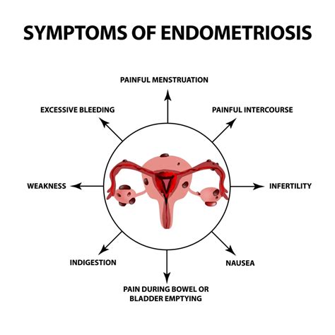 Endometriosis: Causes, Symptoms, Treatments, & More - Neuragenex