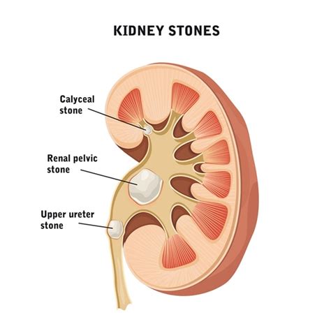 Kidney Stone Diagram