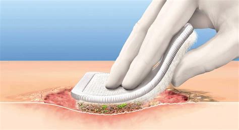 Wound Debridement | Wound Healing | Wound Management