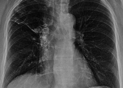 Cureus | A Case of Localized Pulmonary Calcification Presenting as a Persistent Mass Lesion in ...