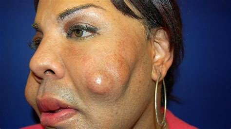 Cosmetic Surgery Disaster: Woman Dubbed 'Cement Face' Given New Lease ...