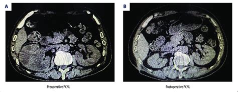 An example image of atrophied kidney after PCNL before/after surgery. A... | Download Scientific ...