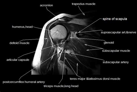 shoulder MRI Diagram | Quizlet