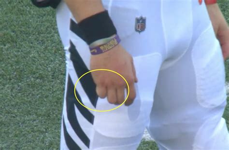 Look: Joe Burrow had badly swollen finger after injury