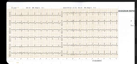 Doctor diagnosed this as RBBB? : r/ReadMyECG