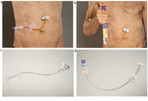 Learn Everything About Percutaneous Endoscopic Gastrostomy, 44% OFF