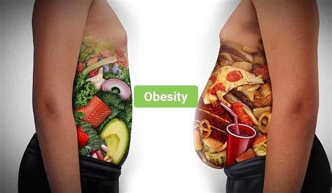 Obesity – Symptoms, Causes, Treatments & More - Healthy Active