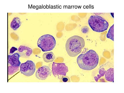 PPT - Macrocytic anemia: B12 & folate PowerPoint Presentation, free ...