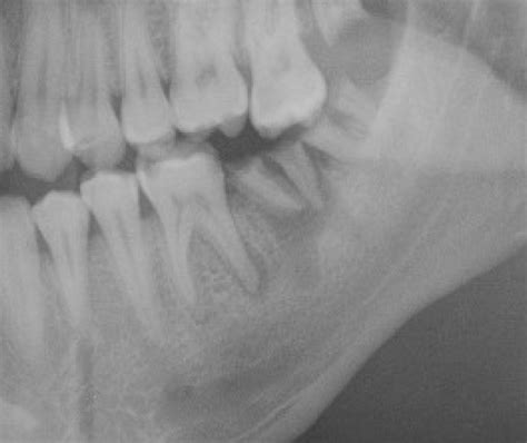 Periapical Abscess Radiograph