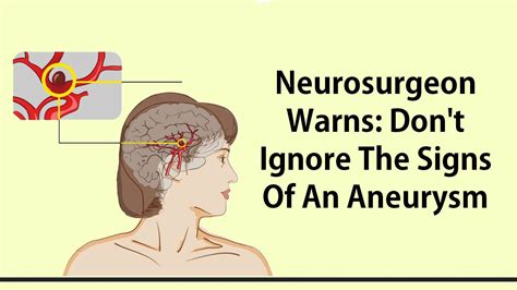 Neurosurgeon Warns: Don't Ignore The Signs Of An Aneurysm