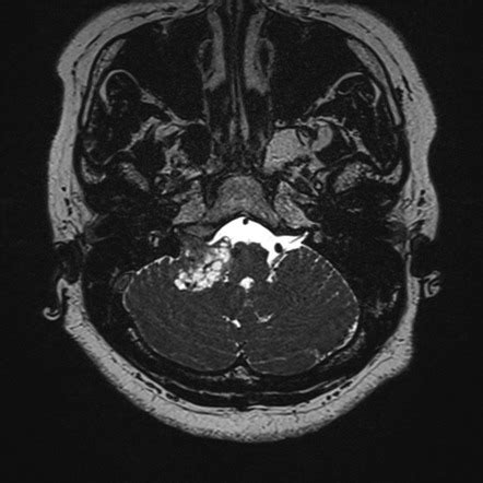 Jugular foramen schwannoma | Radiology Reference Article | Radiopaedia.org