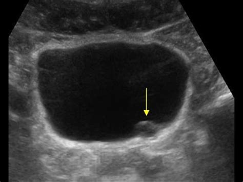 Urinary Tract and male reproductive system | 2.2 Bladder : Case 2.2.3 Miscellaneous bladder and ...