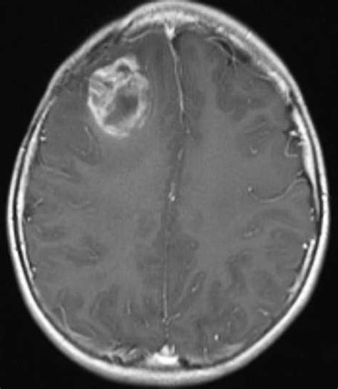 Perfusion Imaging - Questions and Answers in MRI