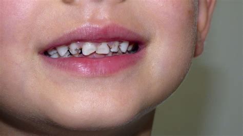 Tooth Decay in Children: Contagious Cavities & Prevention