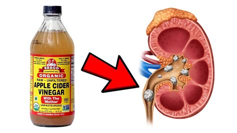 How to Use Apple Cider Vinegar for Kidney Stones - YouTube