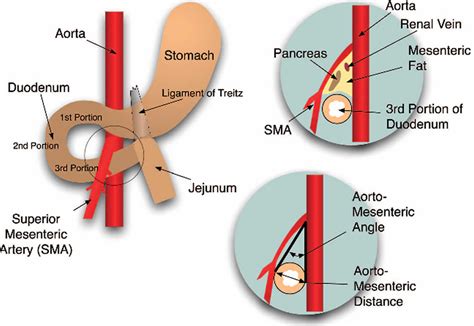 SMA syndrome causes, symptoms, diagnosis, treatment & prognosis