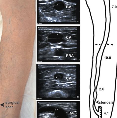 Av Fistula Ultrasound Worksheet