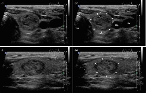 Multinodular Goiter | Radiology Key