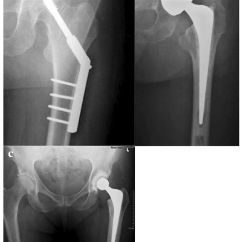 Osteoporosis medications: special considerations and contraindications ...