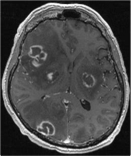 Structural MRI in Idiopathic Parkinson Disease and Parkinsonism ...