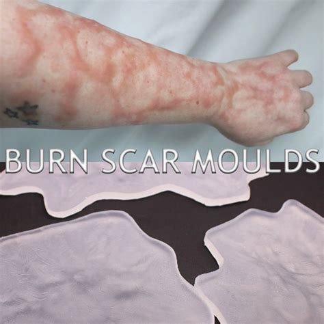 Healed Burn Scars Silicone Bondo Moulds // Scarring Injury Wounds // Prosthetics // SFX MAKEUP ...