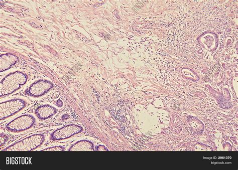 Colon Cancer Histology Image & Photo (Free Trial) | Bigstock