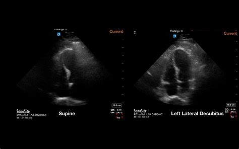 Cureus | Comparison of the Quality of Echocardiography Imaging Between the Left Lateral ...