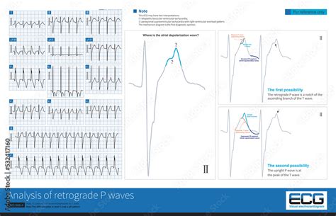 During an episode of tachycardia, retrograde P waves can overlap any ...