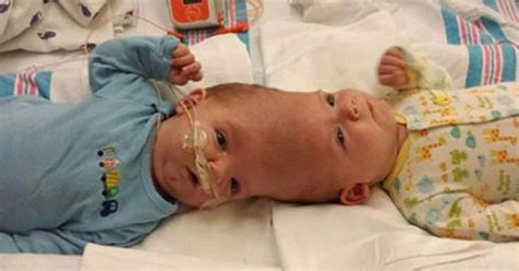 Conjoined Twins Finally Separated After 16 Hour Surgery - us.abrozzi.com