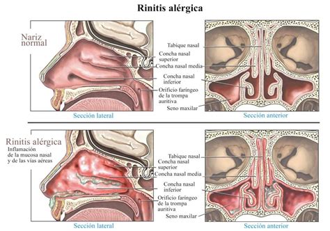 Rinitis Crónica: Tratamiento con Cirugía de Radiofrecuencia de Cornetes