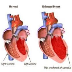 Five Major Causes Of Enlarged Heart - Reasons For Enlarged Heart ...