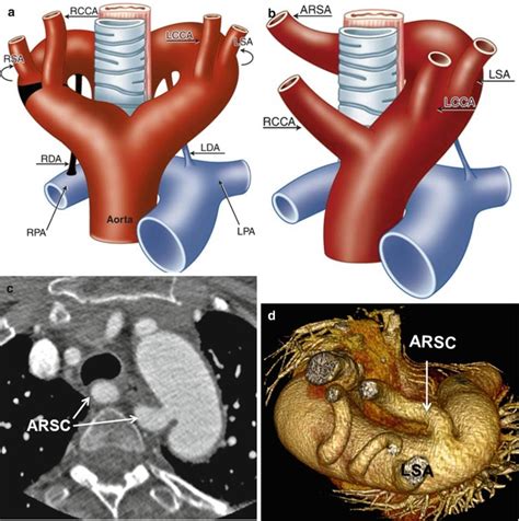 Congenital Variants And Anomalies Of The Aortic Arch Radiographics | My ...