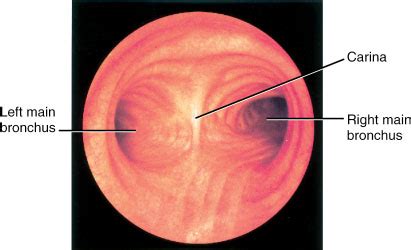 Bronchoscopy