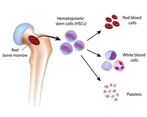 Acute promyelocytic leukemia: MedlinePlus Genetics