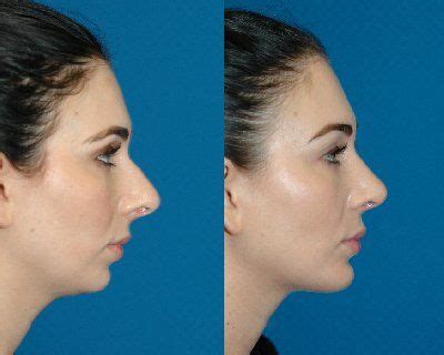 open rhinoplasty and chin implant | Chin implant, Rhinoplasty, Rhinoplasty nose jobs