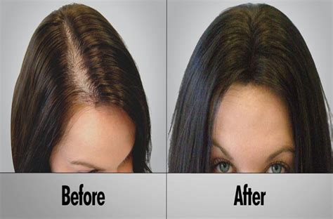 Best Hair Loss Treatment for Female