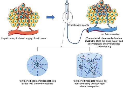 Frontiers | Recent Advances on Polymeric Beads or Hydrogels as Embolization Agents for Improved ...