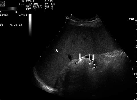 Splenic Artery Aneurysm Ultrasound