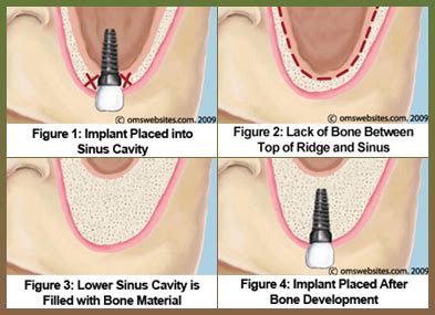 Sinus Lift – Lake Country