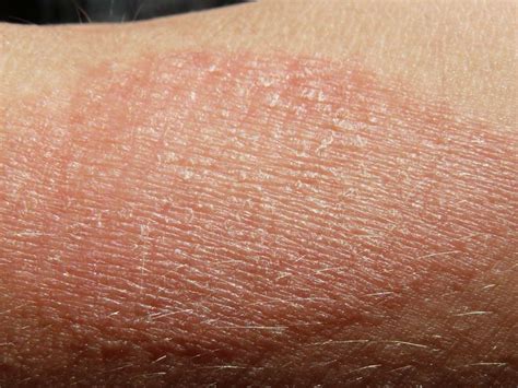 How to treat sunburn this summer