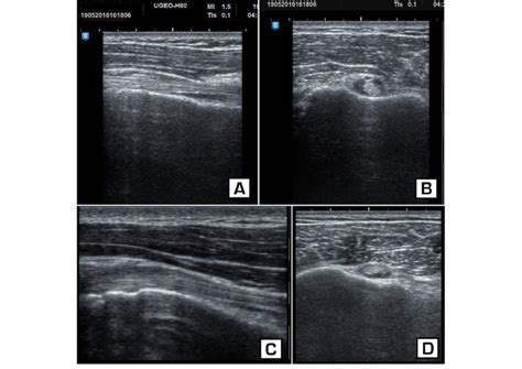 2020 Ultrasound In Distal Biceps Tendon Injuries Youtube