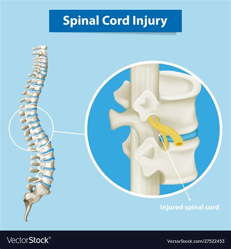 Diagram showing spinal cord injury Royalty Free Vector Image