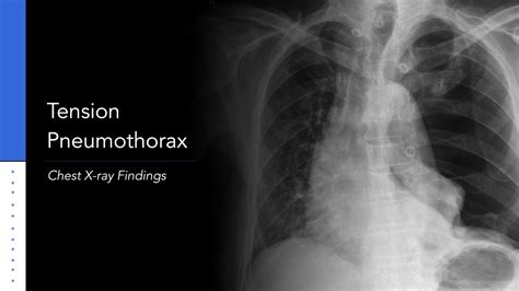 Tension Pneumothorax: Explanation of Chest X-ray Findings - YouTube