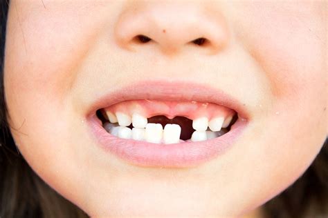 Helping Your Child Through Dental Emergencies - 5 Ways