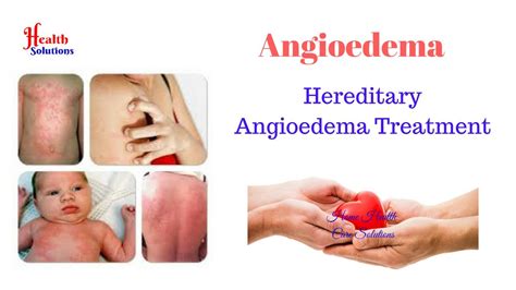 Hereditary Angioedema