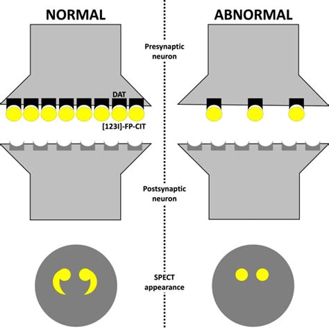 Dopamine transporter radiotracer mechanism. Abbreviations: DAT,... | Download Scientific Diagram