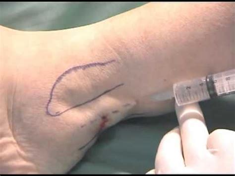 Sural Nerve Biopsy - YouTube